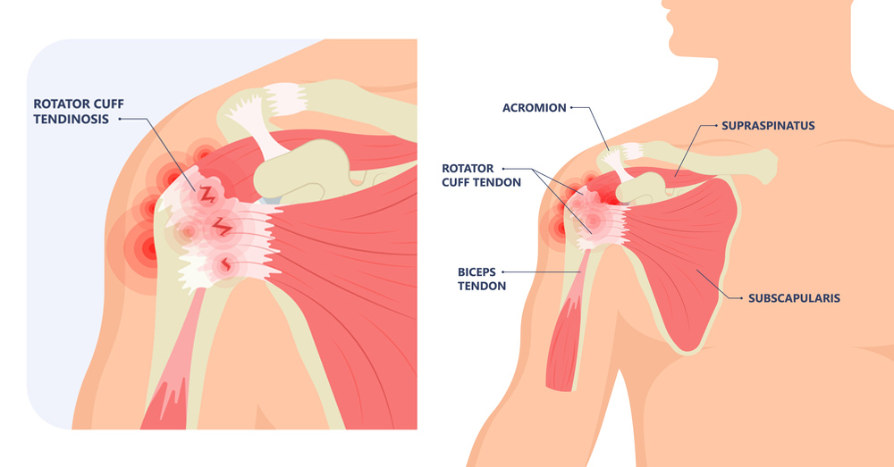 shoulder arthroscopy in Delhi