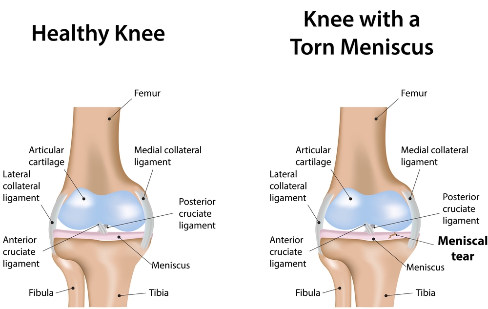 Knee Replacement Surgeon in Delhi